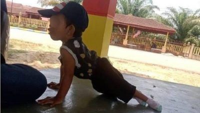 2岁童天生无髋骨患肾病 母心痛：他拖着脚也要走