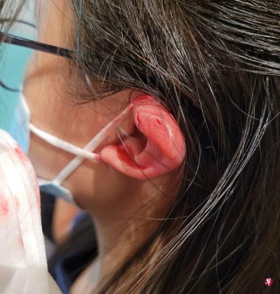 （已签发）柔：狮城二三事：一家四口游飞禽公园 13岁女生被鹦鹉啄伤左耳