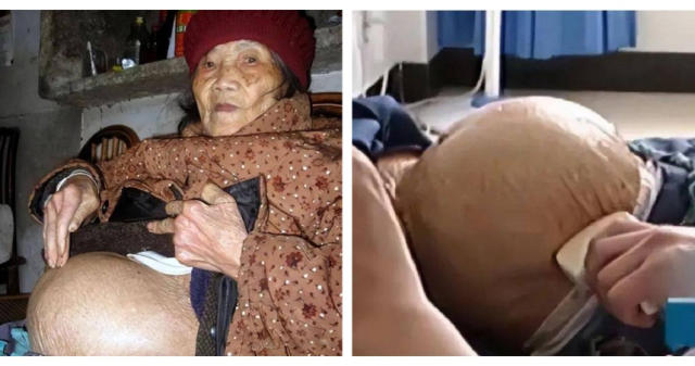 91岁老妇人摔一跤到医院“查出怀孕” 她摔出深藏60年的秘密