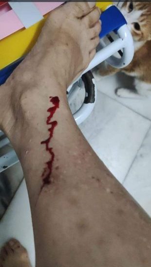 （已签发）柔：住家门前遭2野狗攻击，女市议员右小腿被咬伤
