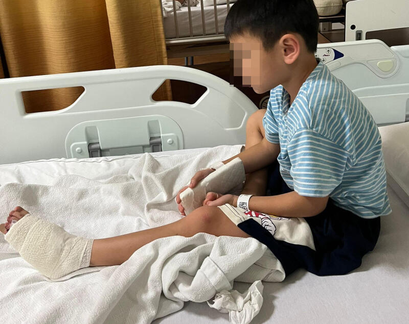 （已签发）柔：狮城二三事：6岁男童脚趾卷入电动扶梯 尾趾脱臼急动手术