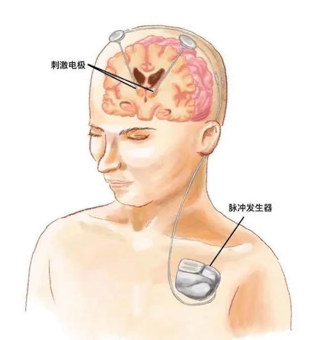 拼盘／中国首例具感知功能“脑起搏器”成功植入　助癫痫患者精准调控治疗