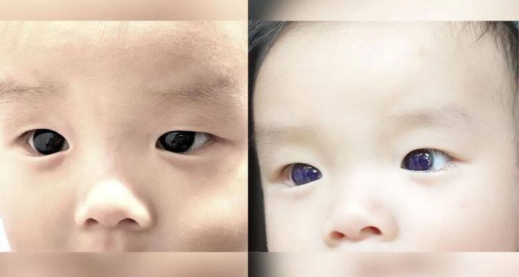 服用“法匹拉韦”治疗冠病 半岁大男婴黑眼变蓝眼