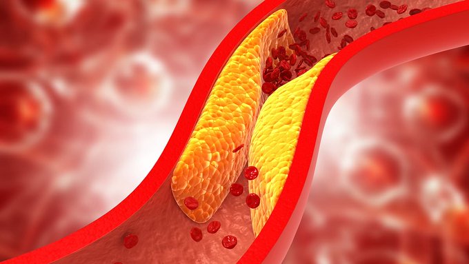美科学家研发降坏胆固醇疫苗 减少心脏病中风风险