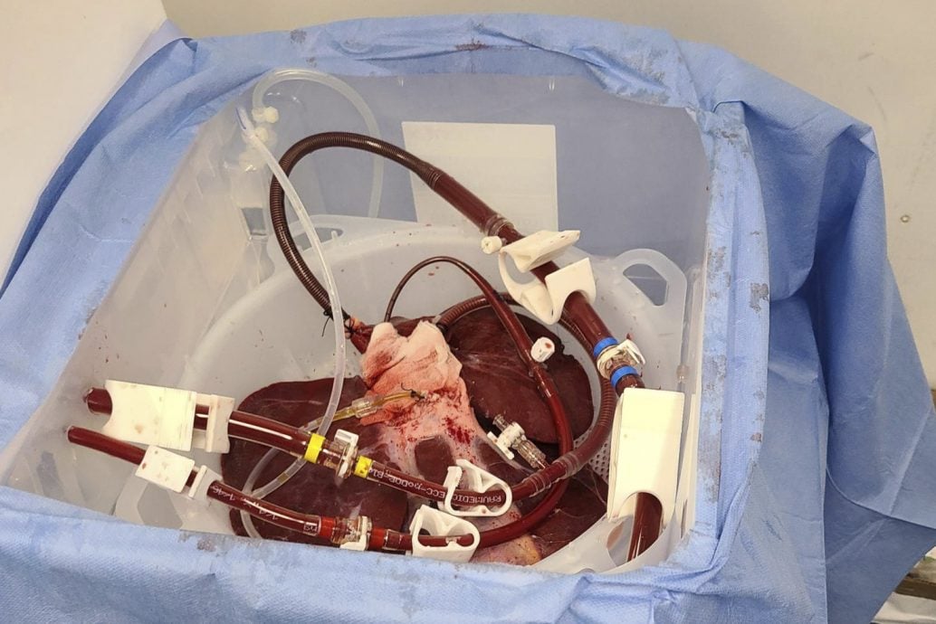 拚盘)美科学家首次将猪肝移植到人体　成功过滤血液72小时