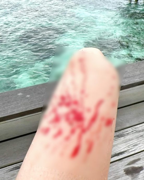 陈浩民爱妻游泳被珊瑚划伤　大腿溅血恐留疤