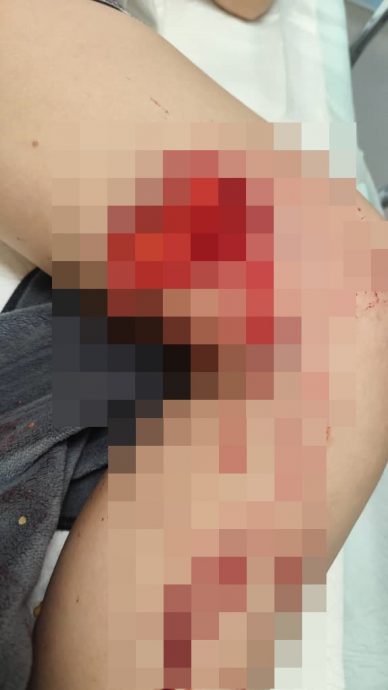 （大北马）华裔妇女被3恶犬噬咬，过年每天折返医院洗伤口