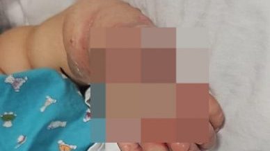 吊点滴致婴儿左手严重肿胀 家属控诉医护人员疏忽