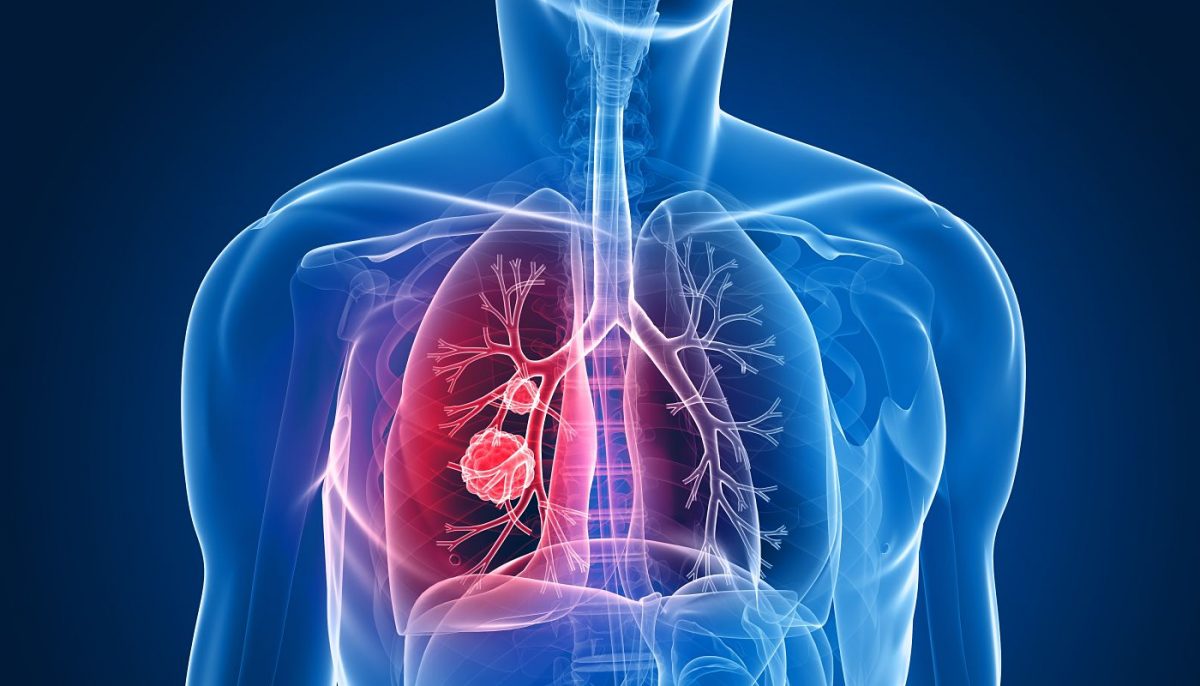科学家研发“开创性”肺癌疫苗 研究显示可预防高达9成病例