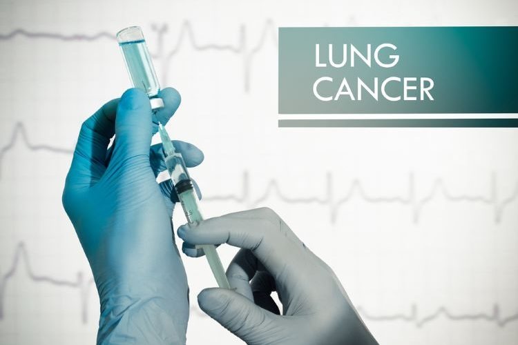 科学家研发“开创性”肺癌疫苗 研究显示可预防高达9成病例