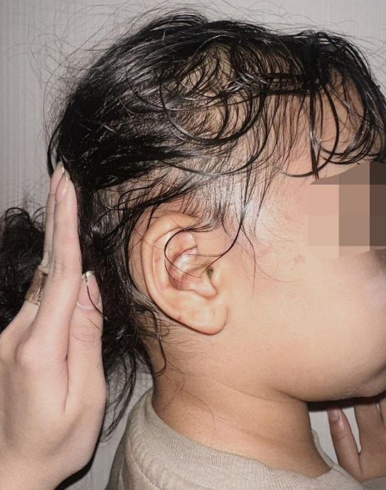 印尼网红4岁女遭保姆虐打 眼睛耳朵严重淤青