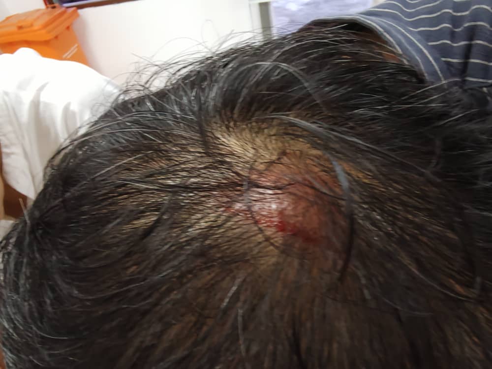 黄思汉遭白板砸伤头部 送院治疗后 今午继续竞选行程