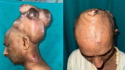 头顶7公斤巨瘤30年！印度男子结束“硬颈”人生